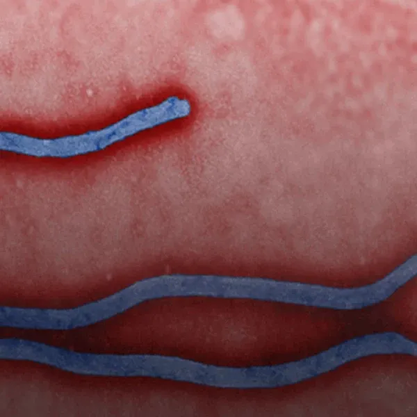 Ebola
